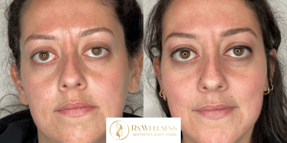 Jawline & Chin Filler 2